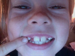 lost a tooth